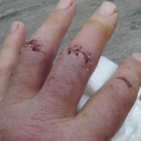 chopped finger club  