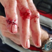 chopped finger club  